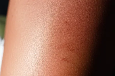 Illustration sunburnt