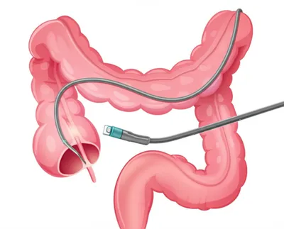 Illustration colonoscope