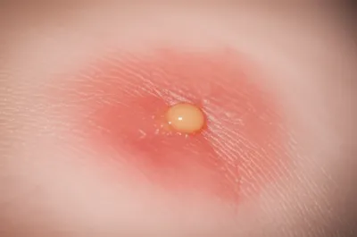 Illustration suppurate - Image 1