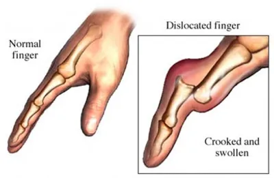 Illustration dislocation - Image 2