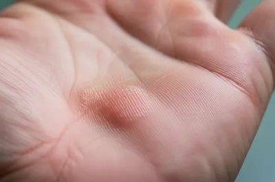 Illustration callous - Image 1