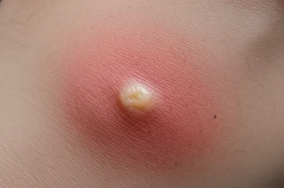 Illustration boils - Image 1