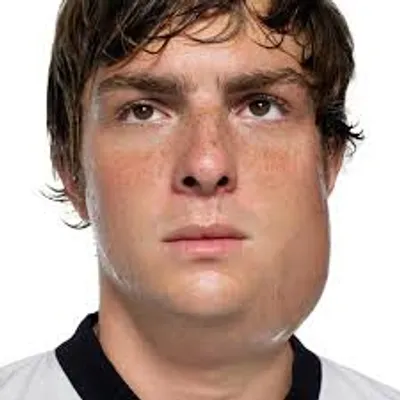 Illustration mumps - Image 2