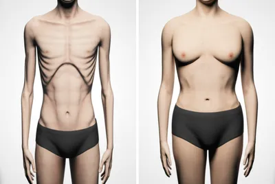 Illustration underweight - Image 1