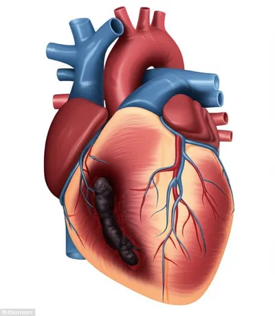 Illustration infarct