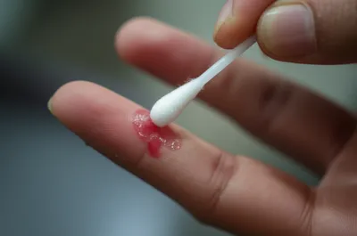 Illustration styptic