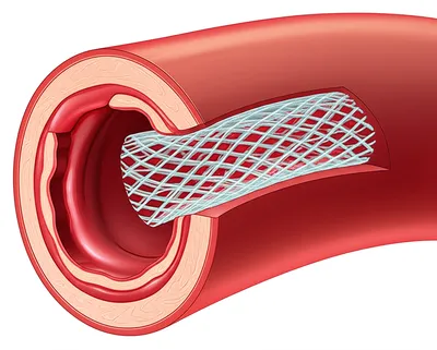 Illustration stents - Image 1
