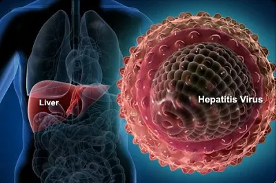 Illustration hepatitis - Image 2
