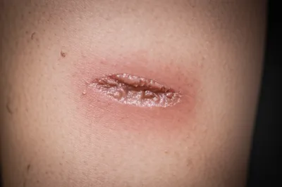 Illustration ulcer - Image 1