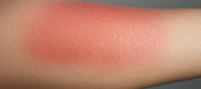 Illustration erythema - Image 1