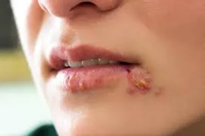 Illustration herpes - Image 2