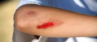 Illustration wound - Image 2