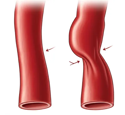Illustration dilatation - Image 1