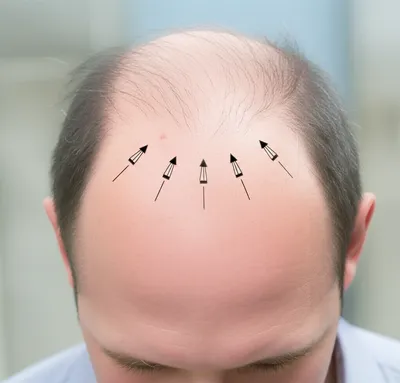 Illustration receding - Image 1