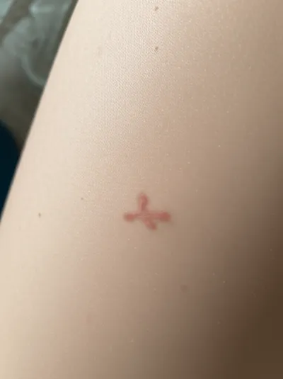 Illustration birthmarks