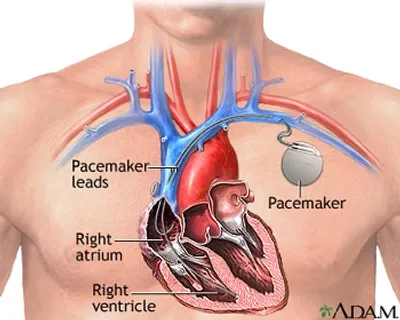 Illustration pacemaker - Image 2