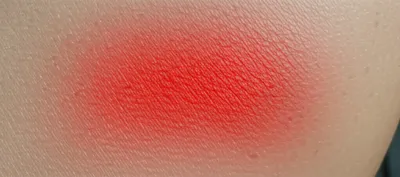 Illustration erythema