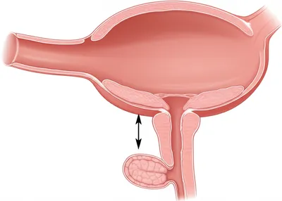 Illustration uvula - Image 1