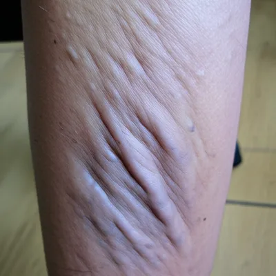 Illustration varicose