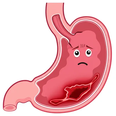 Illustration ulcers - Image 1