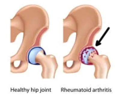 Illustration arthritis - Image 2