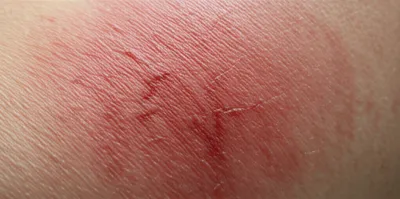 Illustration cellulitis