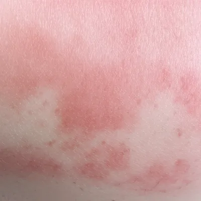 Illustration sunburned - Image 1