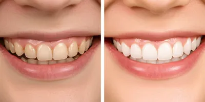 Illustration orthodontia