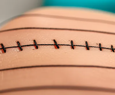 Illustration suture