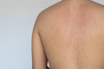 Illustration welted - Image 1