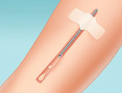 Illustration infiltrated - Image 1