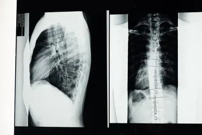 Illustration scoliosis - Image 2