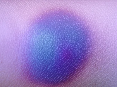 Illustration hematomas