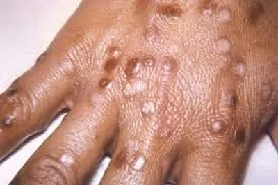 Illustration smallpox - Image 2
