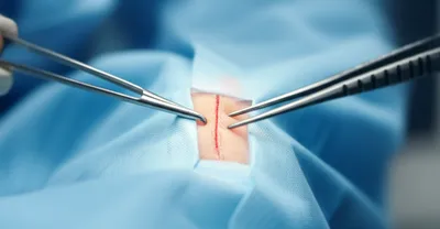 Illustration incisions