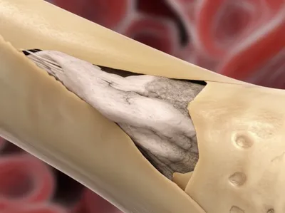 Illustration sequestrum - Image 1