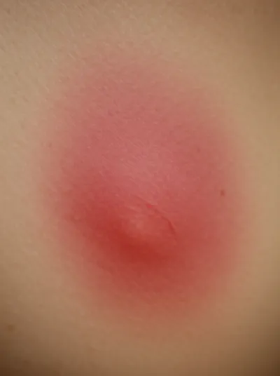 Illustration abscesses - Image 1