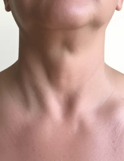 Illustration struma - Image 1