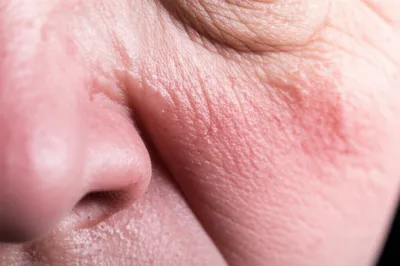 Illustration chafes - Image 1