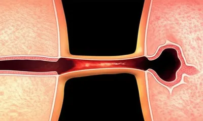 Illustration fistula - Image 1