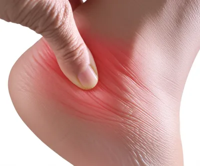 Illustration inflame - Image 1