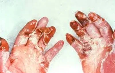 Illustration frostbite - Image 2