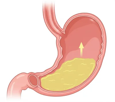 Illustration reflux - Image 1
