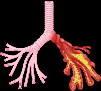 Illustration bronchitis