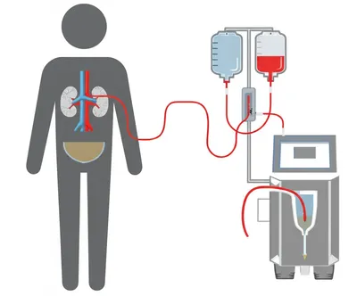 Illustration dialysis - Image 1