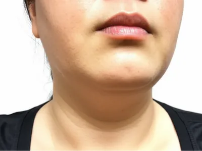 Illustration goiter - Image 1