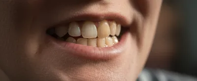 Illustration attrition - Image 1