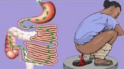 Illustration dysentery - Image 2