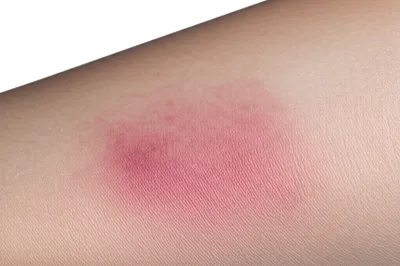 Illustration bruise - Image 1