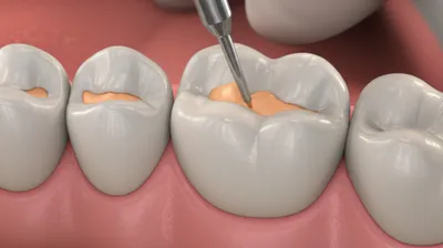 Illustration inlaying - Image 1